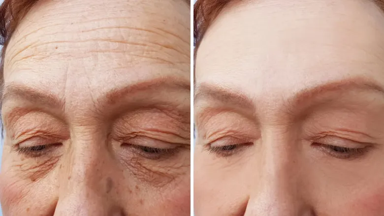 Antes e Depois 1 