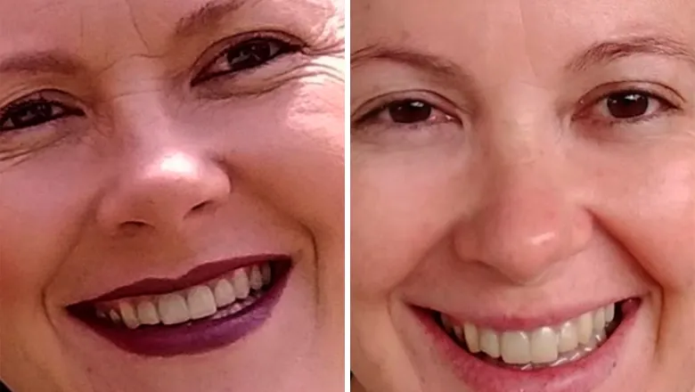 Antes e Depois 3 