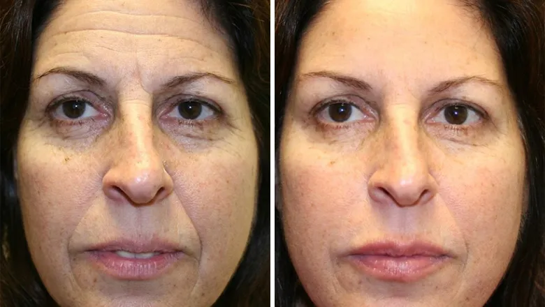 Antes e Depois 4 