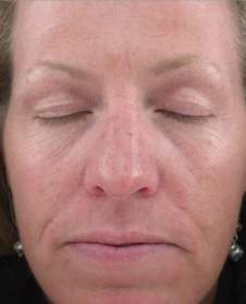 Antes de usar Lift Gold