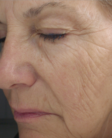 Antes de usar Lift Gold