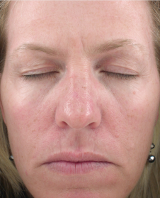 Depois de usar Lift Gold