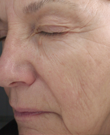 Depois de usar Lift Gold